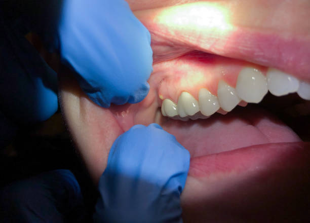 Best Emergency Dentist for Knocked-Out Tooth in Luna Pier, MI