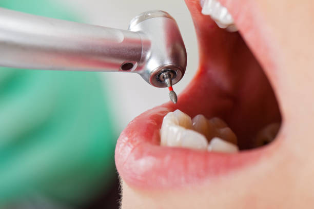 Best Emergency Dental Extractions in Luna Pier, MI